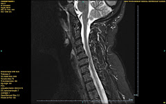 spine inpingement stenosis