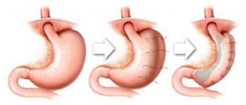 Super Sleeve or Gastric Plication surgery