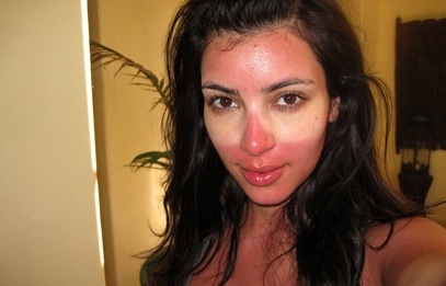 kim-kardashian-sunburn.JPG