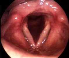 Vocal Cords