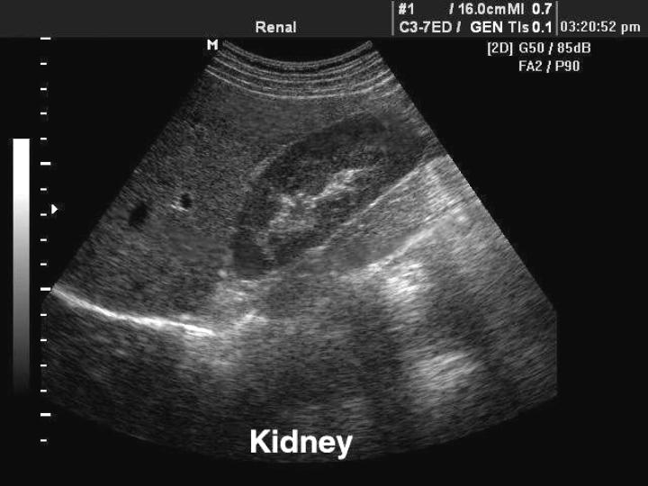 Kidney