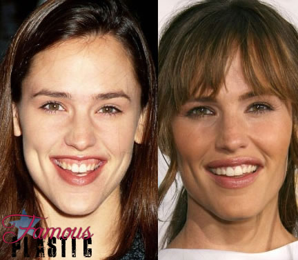How To Get Rid Of A Gummy Smile Naturally How To Get Rid Of A Gummy Smile Naturally