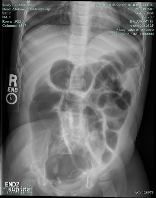 Bowel Distention