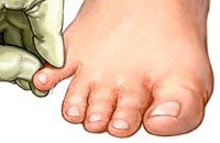 Pinky Toe Amputation