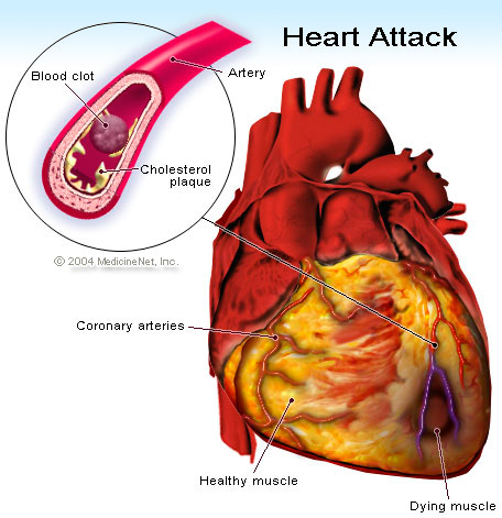 Зүрх судас ны өвчнөөс ангижирцгаая