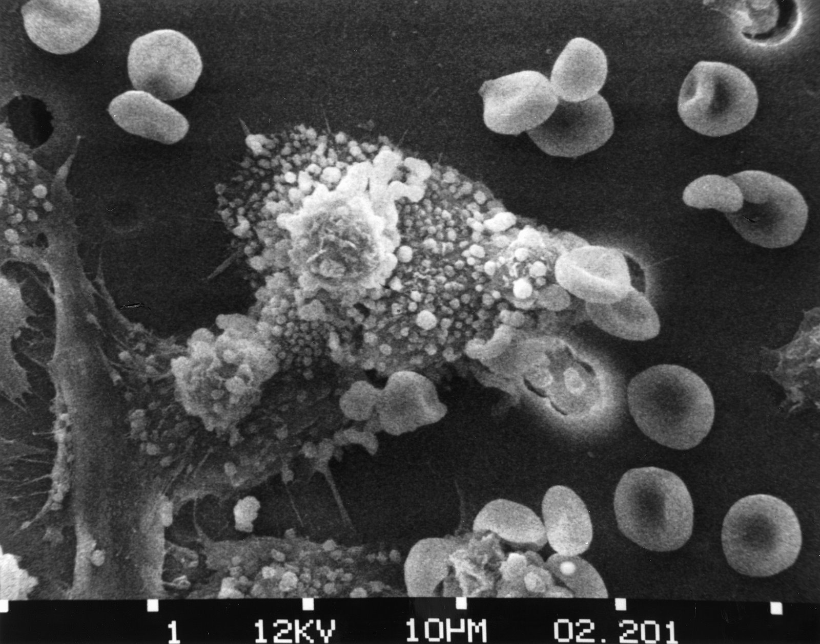 [20061004031648!Macs_killing_cancer_cell.jpg]