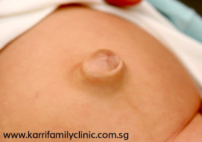 adult umbilical hernia pictures
