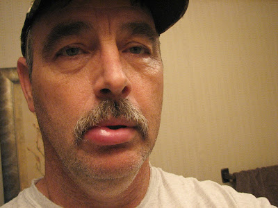 Botox Overdose