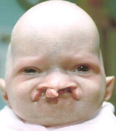 In the US, her cleft lip and cleft lip before and after. In the US, her cleft lip and