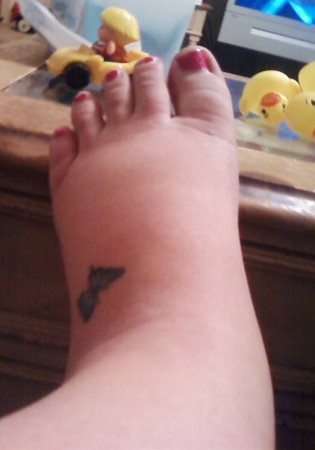 [swollenfoot.jpg]