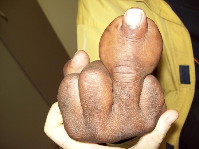 Fat+finger.JPG