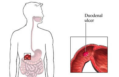 [Ulcera+duodenal+1.jpg]
