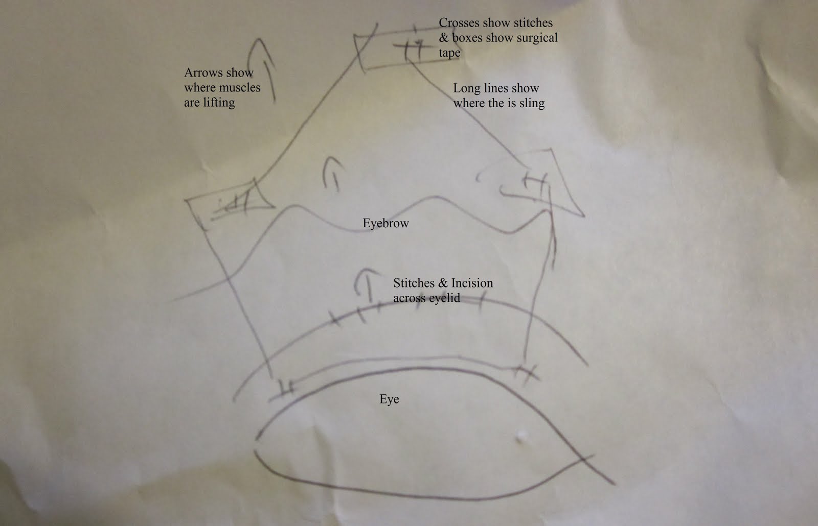 Congential Ptosis and Frontalis Sling Surgery 2nd SurgeryFrontalis