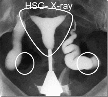 uterine polyps caused by clomid