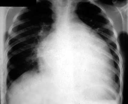 of dilated cardiomyopathy,