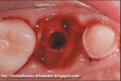 schneiderian membrane