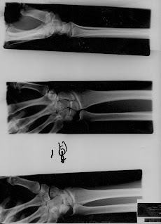 CLINICA 2000: Fractura de escafoides carpiano