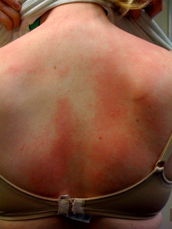 So after 3 months of Wellbutrin Rash Pictures. So after 3 months of