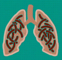 Tuberculosis lung disease illustration.