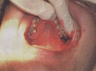 A tooth bleeding which being inspected by a dentist.