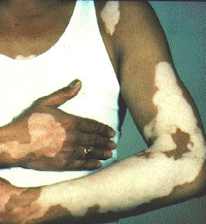 vitiligo