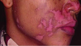 vitiligo treatments