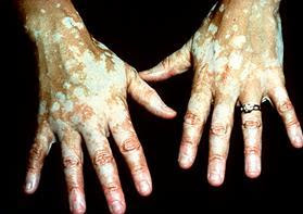 vitiligo cure