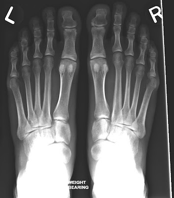 X Ray Toe