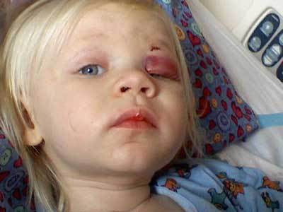 Niña Accidentada