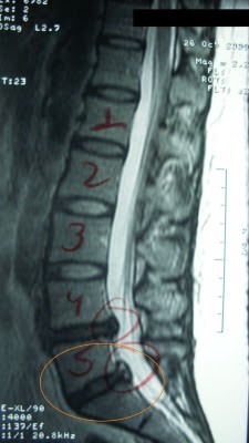 Exame hernia de disco