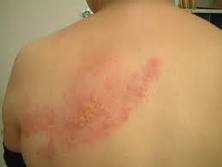 cara mengobati herpes