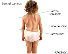 Scoliosis - What it looks like