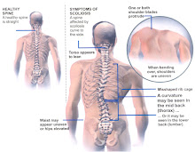 Scoliosis runs in families.....