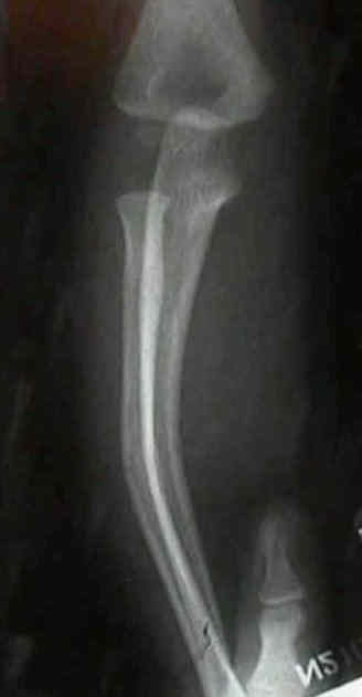 Treatment Of Fractures common way to get a Greenstick fracture is to fall and cause blunt -4.bp.blogspot.com