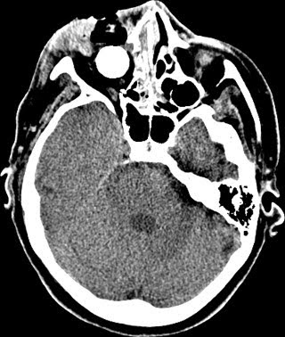 Normal+ct+scan+head