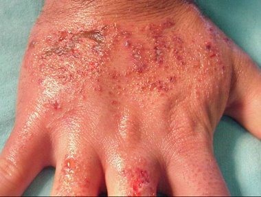 [dermatitis.jpg]
