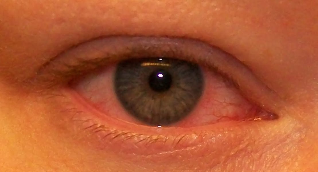 bindhinneinflammation i ögat