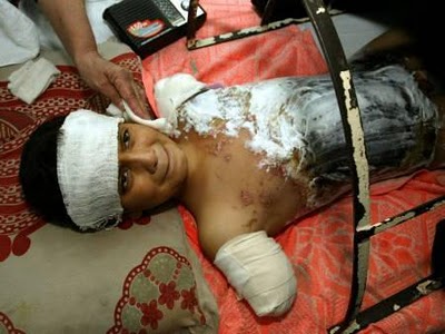http://4.bp.blogspot.com/_KgBT8kIRgBo/TPyNjHY1CAI/AAAAAAAAG80/-OaIOPEjo80/s1600/cluster_bomb_victim.jpg