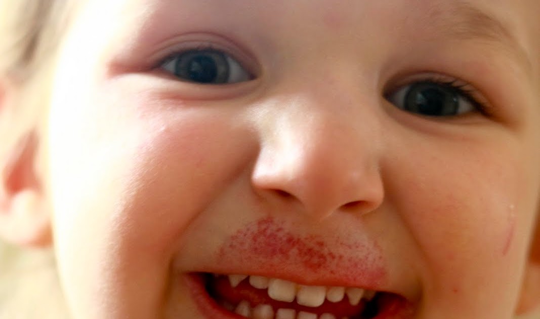 To get rid of a lip hickey