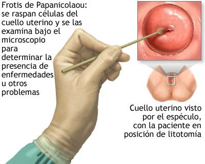 El aumento de la dimensión del miembro por el gel