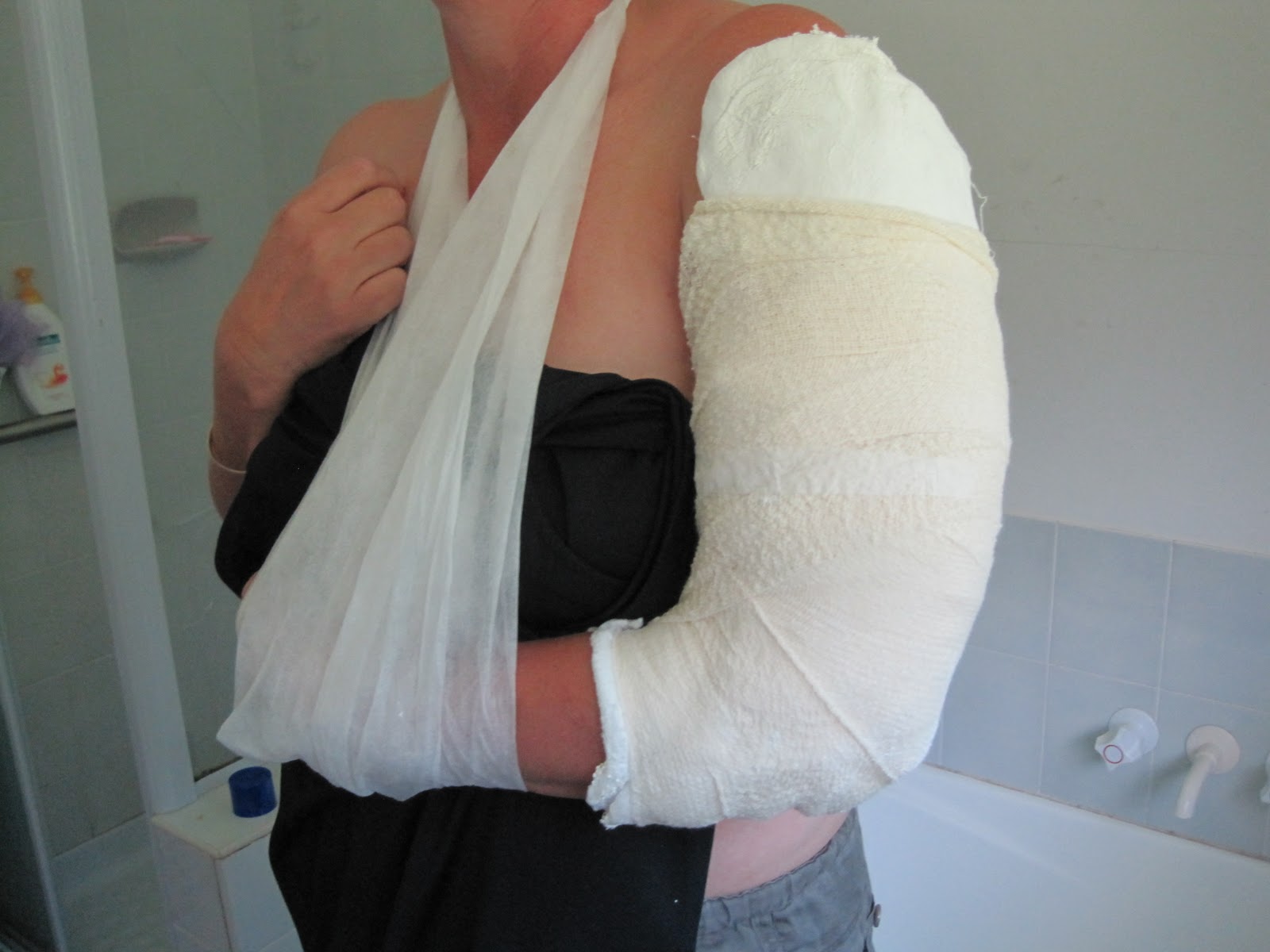 fractured humerus journey Day 1