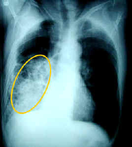 Pneumonia and other forms of
