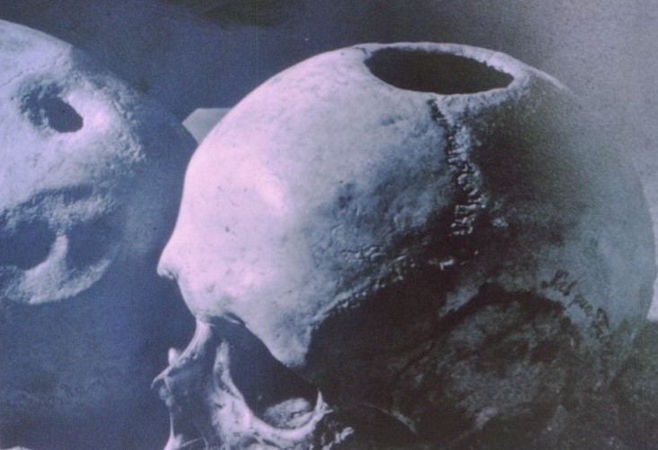 [27+CRANIOTOMIA+DE+10[1].000+ANOS+COM+SOBREVIENCIA1.jpg]