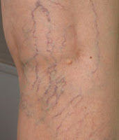 varices jambes