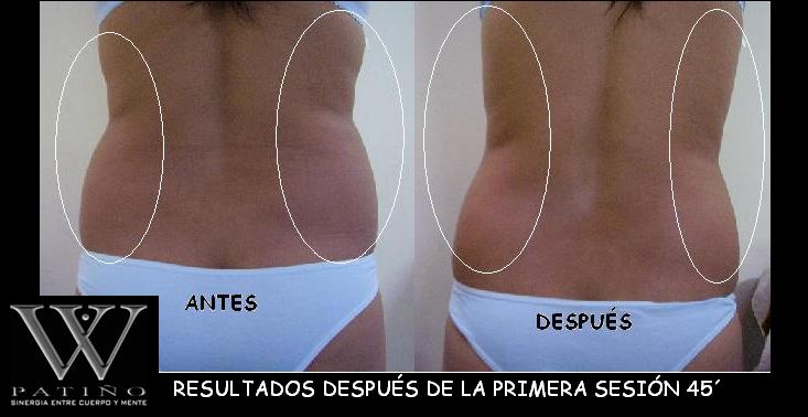 ANTES Y DESPUÉS 3