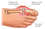 gout symptoms