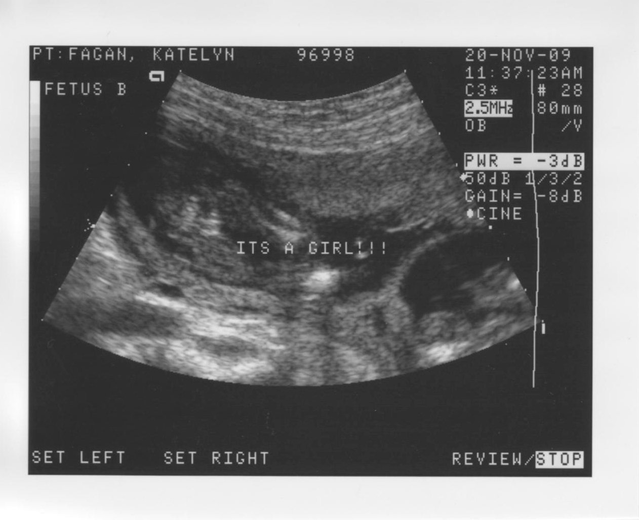 Our first Ultrasound and The Benefits of Having Twins First