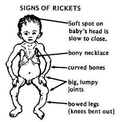rickets vitamin d and mayo clinic Vitamin d deficiency, which classically manifests as bone disease (either rickets or osteomalacia), is characterized by impaired bone mineralization. rickets vitamin d and mayo clinic Vitamin d deficiency, which classically manifests as bone disease (either rickets or osteomalacia), is characterized by impaired bone mineralization.