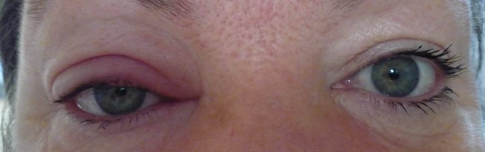 Scratched Eye Swollen Eyelid