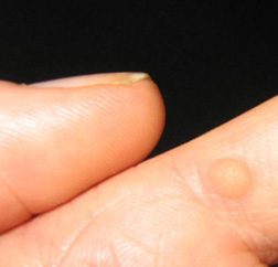 Finger Wart Removal